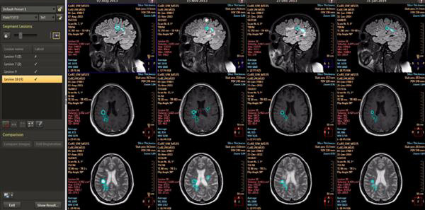 飛利浦發(fā)布其視覺分析和量化平臺(tái)的最新版本